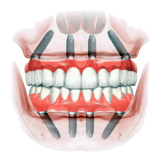 Dentista in Albania, Impianti dentali, protesi dentale fissa e mobile, corone e faccette dentali