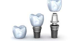 Dentista in Albania, Impianti dentali, protesi dentale fissa e mobile, corone e faccette dentali