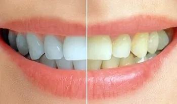 Dentisti in Albania - Union Dental Clinic Tirana