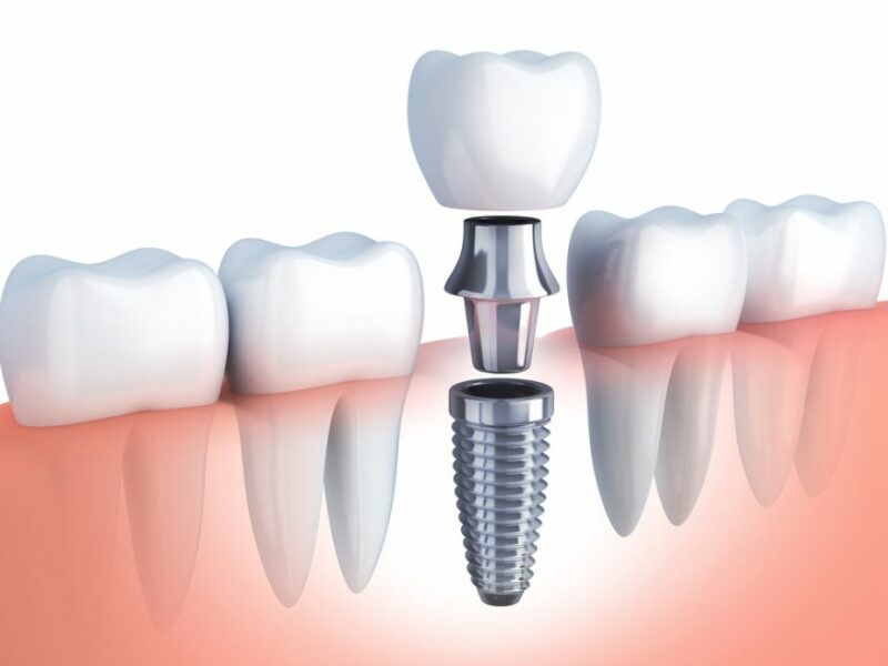 Dentista in Albania, Impianti dentali, protesi dentale fissa e mobile, corone e faccette dentali