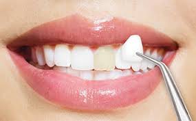 Dentista in Albania, Impianti dentali, protesi dentale fissa e mobile, corone e faccette dentali