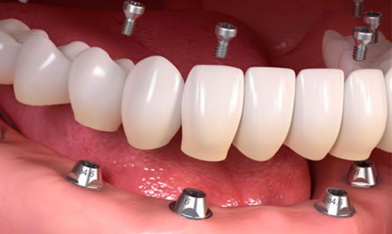 Dentista in Albania, Impianti dentali, protesi dentale fissa e mobile, corone e faccette dentali