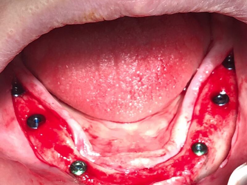 Dentista in Albania, Impianti dentali, protesi dentale fissa e mobile, corone e faccette dentali