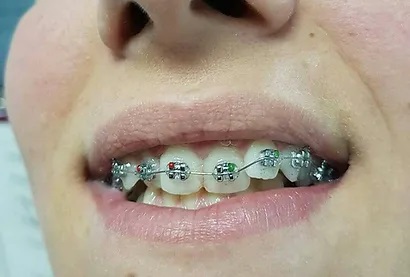 Dentisti in Albania - Union Dental Clinic Tirana