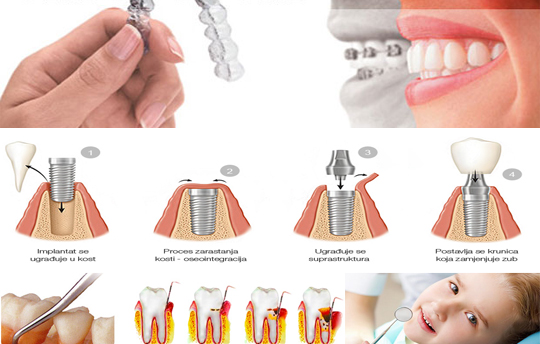 Dentista in Albania, Impianti dentali, protesi dentale fissa e mobile, corone e faccette dentali